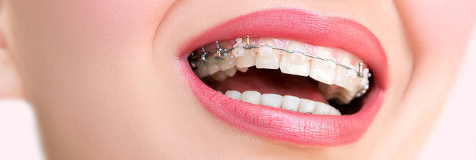 Ceramic Braces