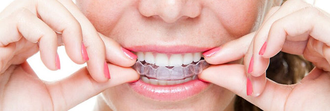 🥇 Invisalign Braces Richardson TX