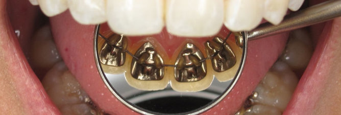 Lingual Braces