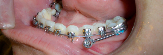 Richardson Invisalign, Braces in Plano